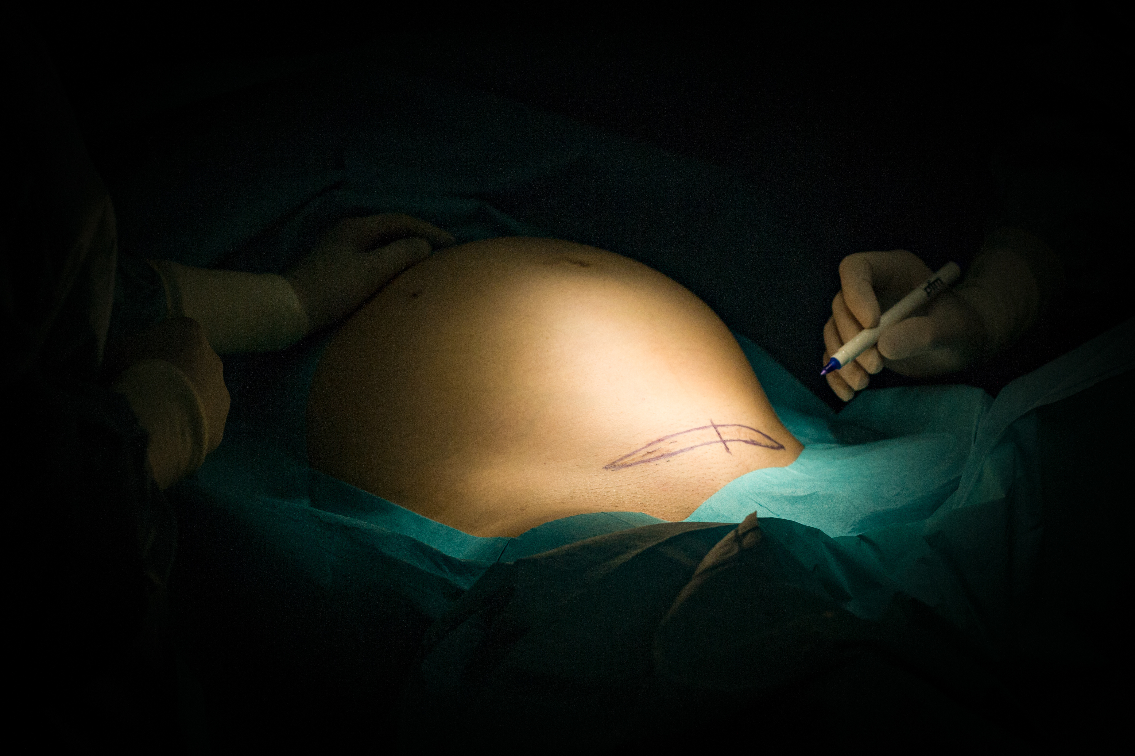 marking on the belly of a pregnant person for caesarean section