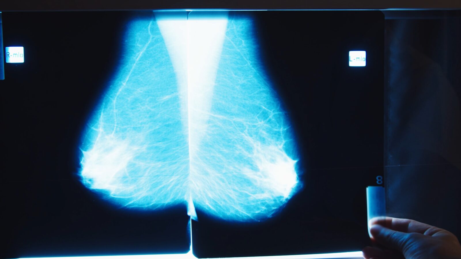a blue scan of breast tissue is lit up against a black background