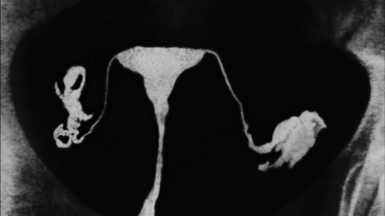 A black and white image of a uterus, ovaries, and the connecting fallopian tubes.