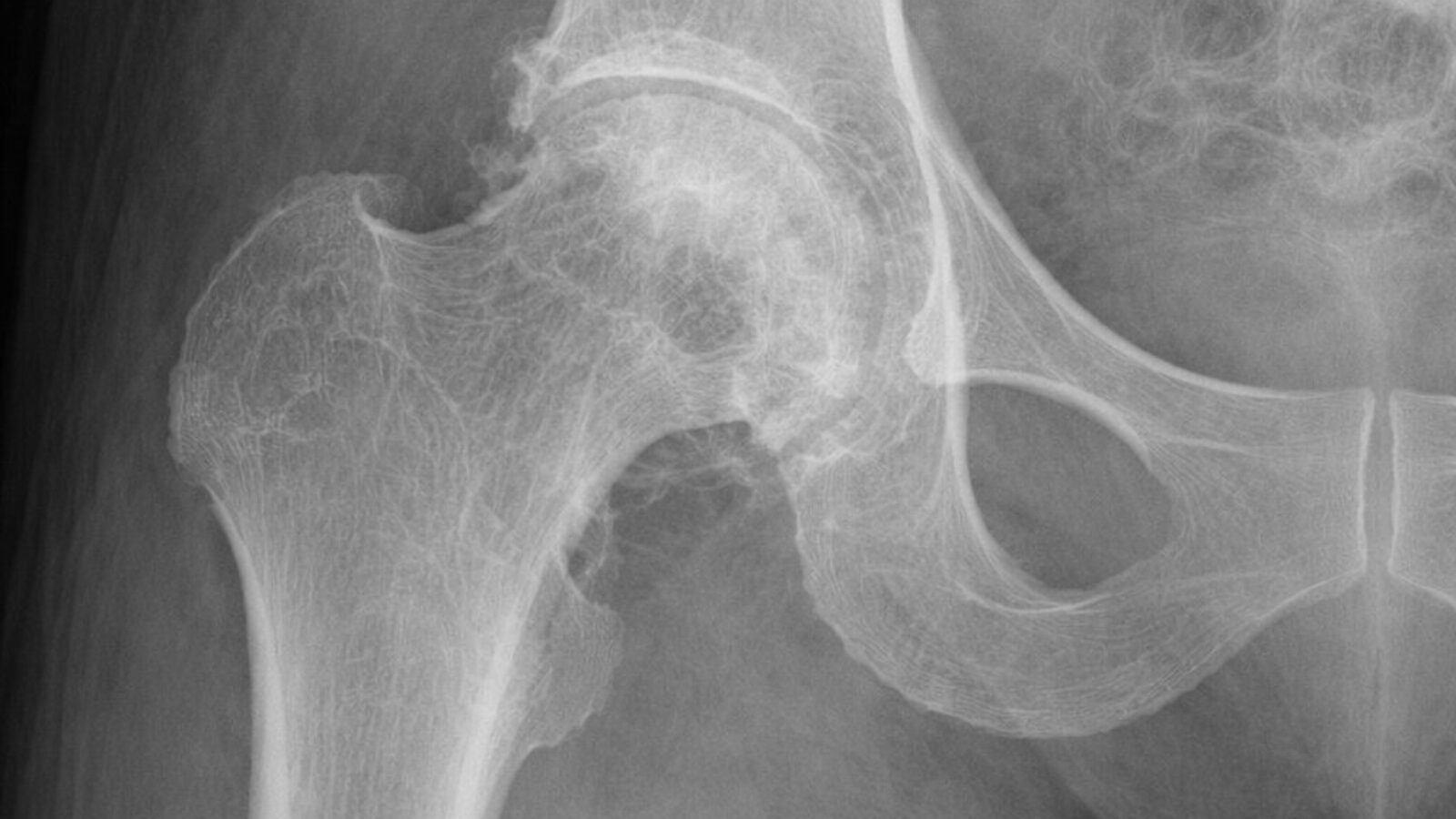 A (spoiler alert) AI generated X-ray of, I think, a hip bone. Very convincing.