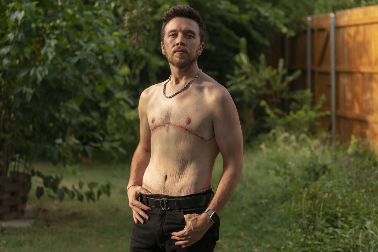 A cisgender man who received multiple plastic surgeries after losing weight stands shirtless with green foliage in the background. He has scars on his cheset.