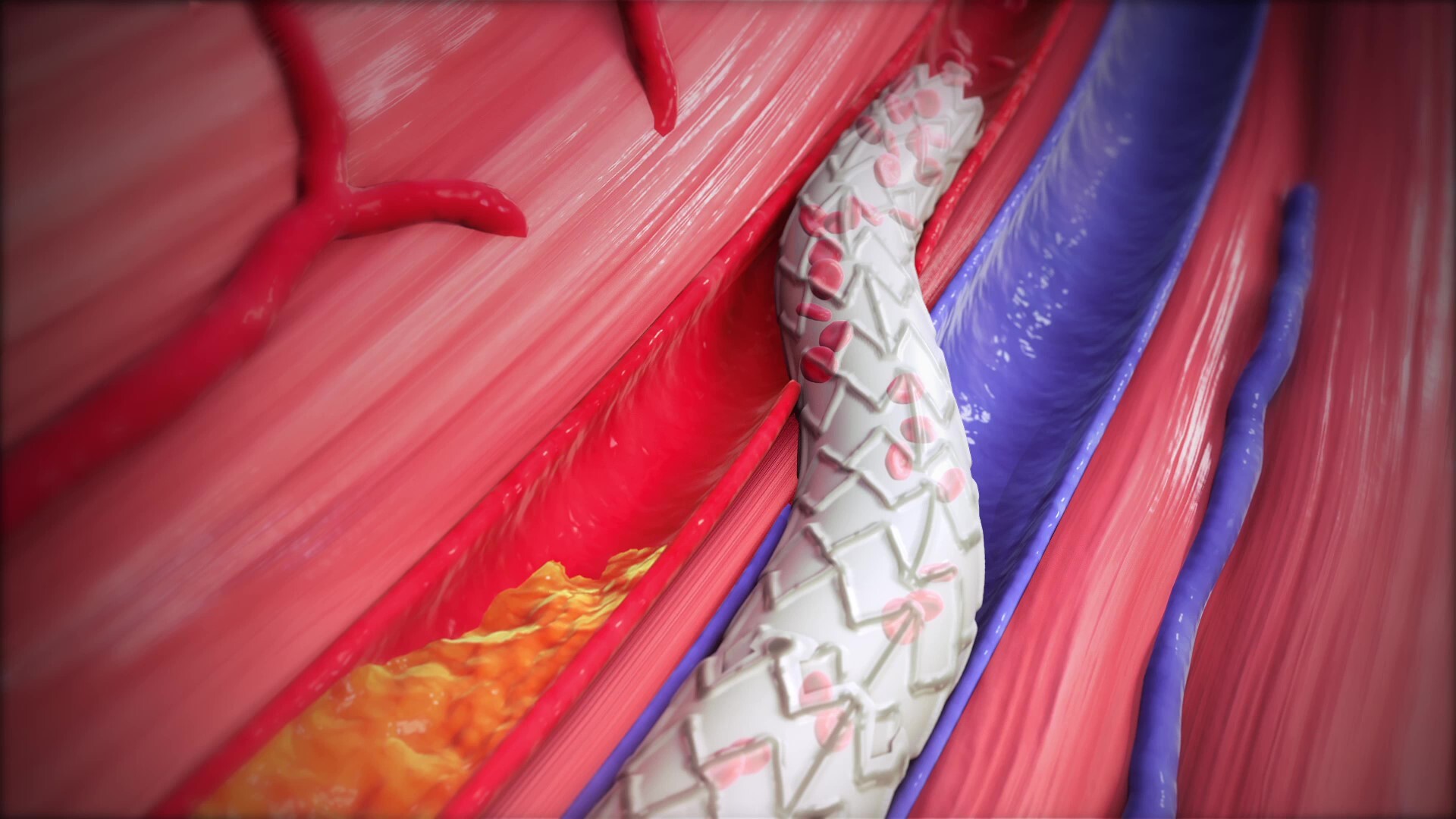 Vein-becoming-artery-with-LimFlow-crossing-stent-1