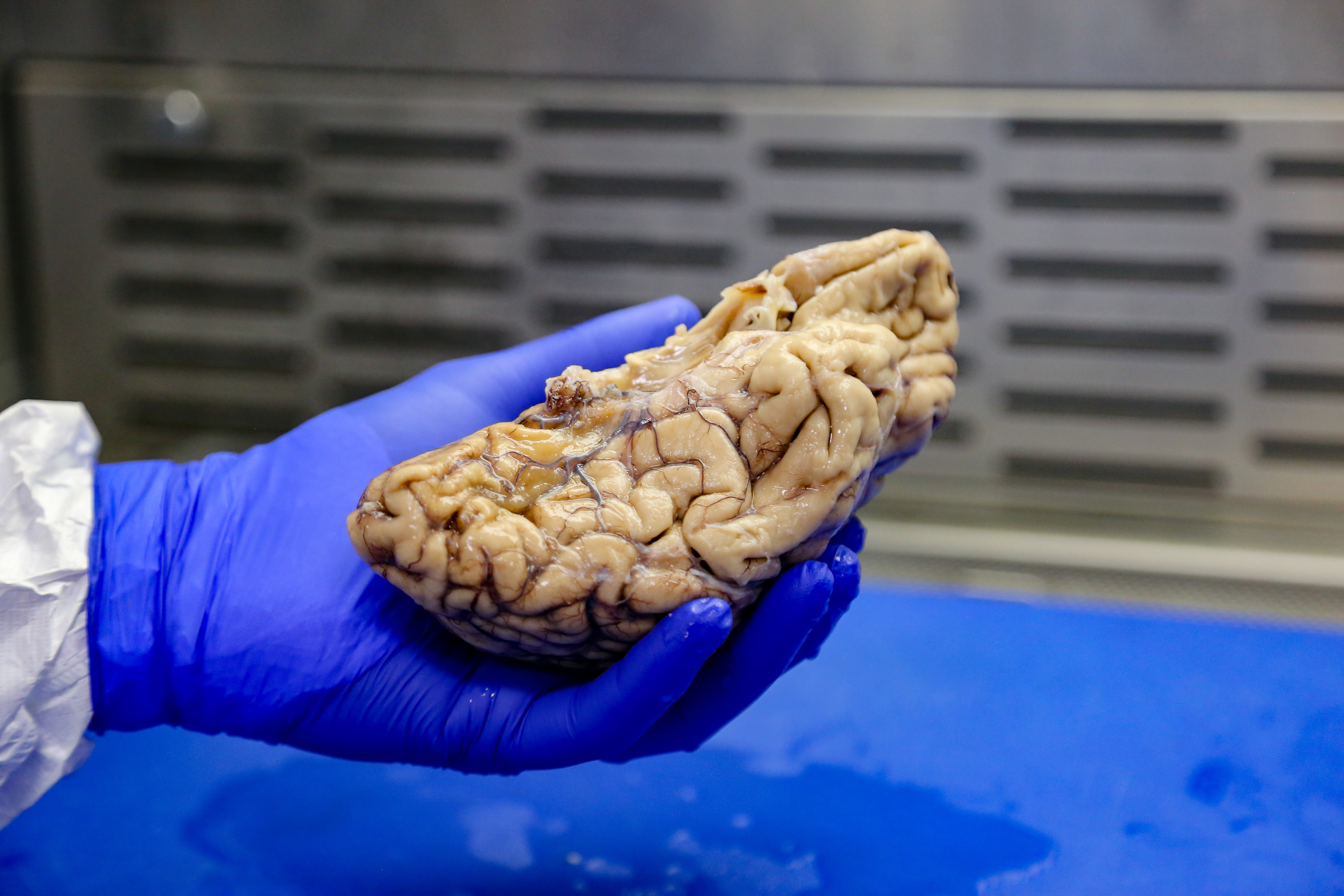 At the Rush Alzheimer's Disease Center in Chicago, pathologist Ryan Johnson holds the brain of a donor