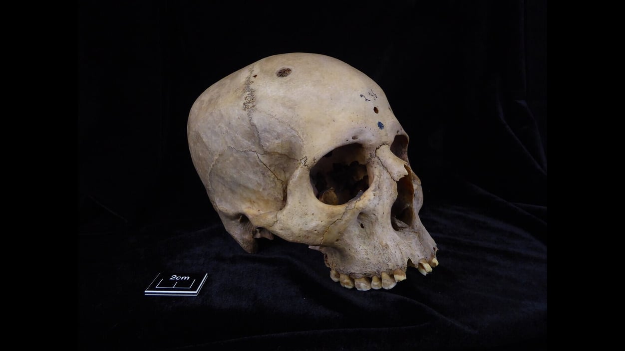 The skull of a man from about 4,000 years ago sits against a black background. A small measurement showing 2 cm sits next to the skull for scale. A small lesion about that size can be seen on the top of the skull.